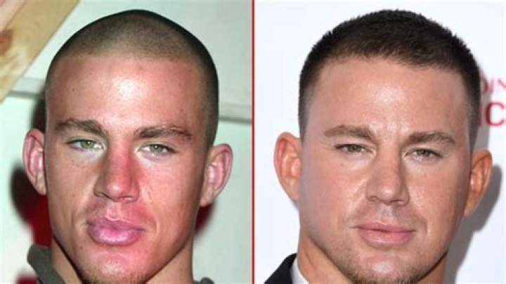 Channing Tatum Plastic Surgery Before and After