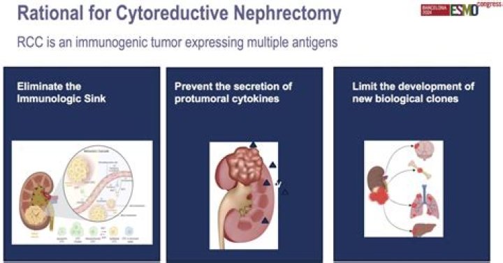Does Cytoreductive Nephrectomy Remain an Essential Component of Care for Advanced Renal Cell Carcinoma?