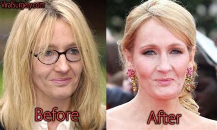 JK Rowling Facelift Plastic Surgery Before and After