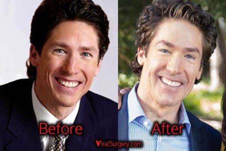 Joel Olsteen Plastic Surgery: Did Joel Osteen have surgery to change his appearance?