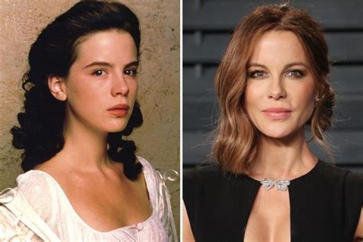 Kate Beckinsale Plastic Surgery Before and After