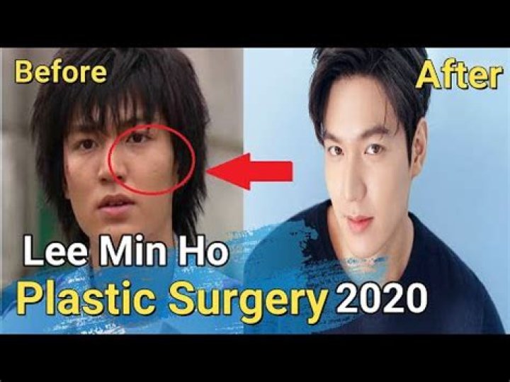 Lee Min-ho Plastic Surgery Before and After