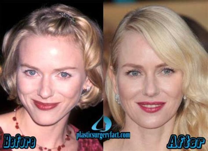 Naomi Watts Plastic Surgery Before and After