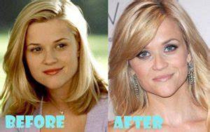Reese Witherspoon Plastic Surgery Before and After